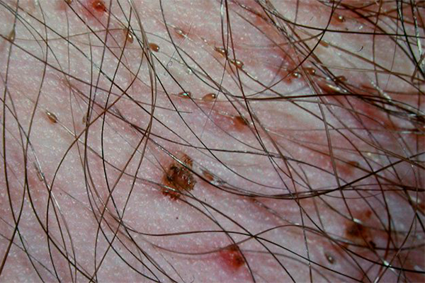 ladillas-síntomas-piojos-pubicos