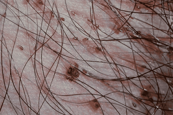 Infecciones de transmisión sexual síntomas