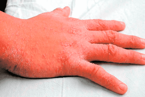 Infecciones de transmisión sexual síntomas