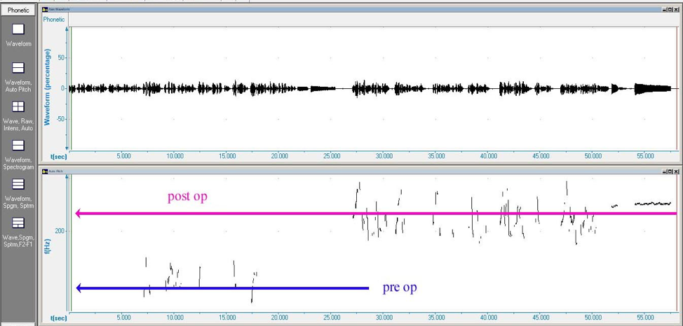 cirugía feminización voz