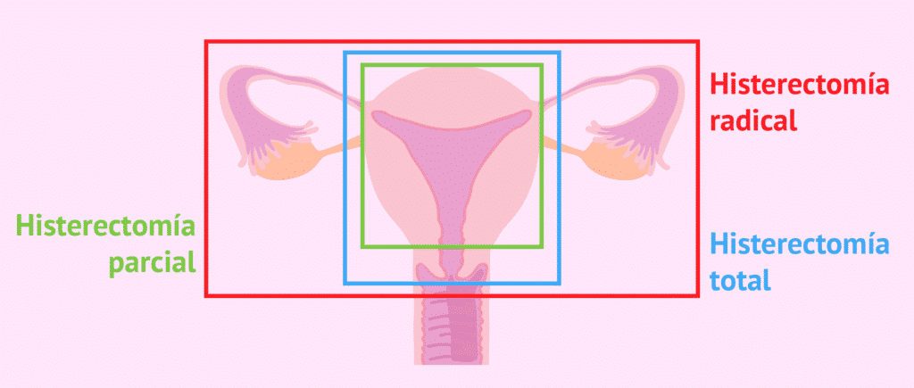 histerectomía procedimiento qué es