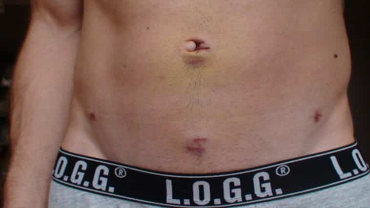 qué-es-histerectomía-2