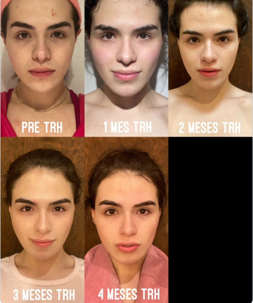 Elvira tratamiento hormonal