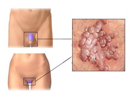 condilomas-hombres-gays