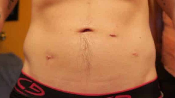 qué es histerectomía hombre trans intersexual