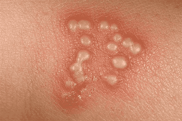 Infecciones de transmisión sexual síntomas