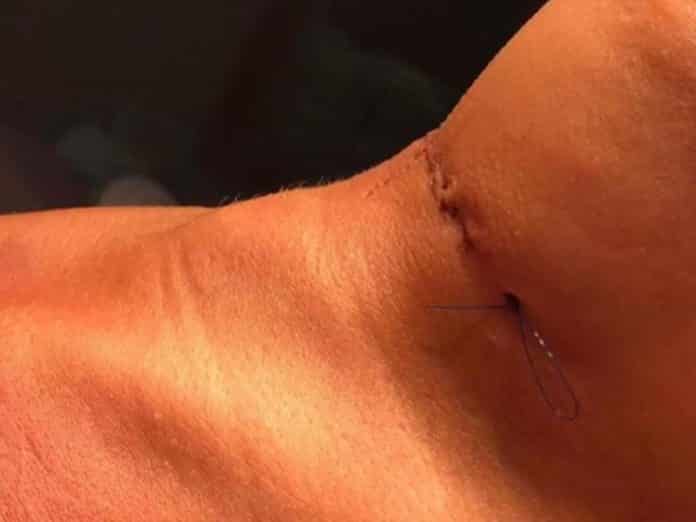 cirugía feminización voz cirugía feminización voz