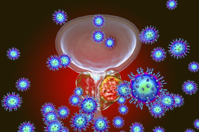 cáncer de próstata