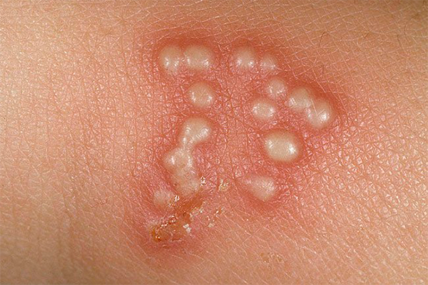 Infecciones-de-transmision-sexual-herpes