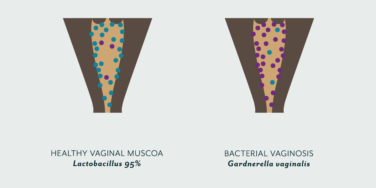 Vaginosis-bacteriana