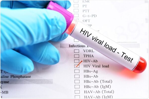 La COVID-19 causó que se postergaran las pruebas de carga viral y la atención para pacientes con VIH