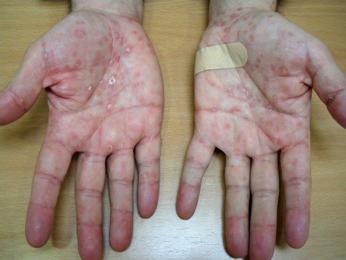 Transmisión de sífilis aumenta en hombres gay durante pandemia