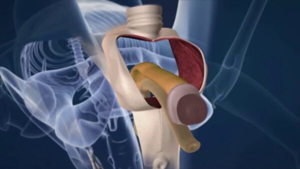 vaginoplastia pasos