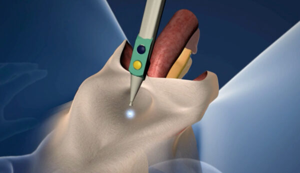vaginoplastia cirugía