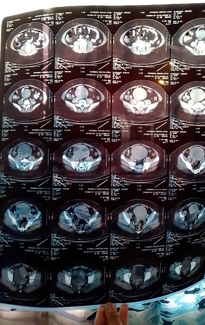 Leiomiomatosis Ricardo Espinoza