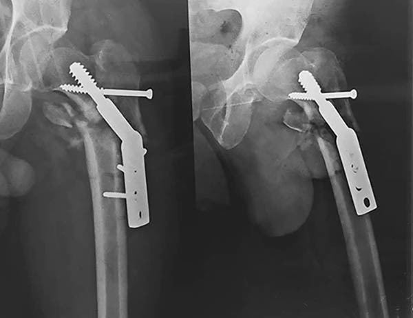 Placa de la operación negligente de Aarón