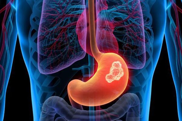 tipos de cancer frecuentes en hombres estómago salud