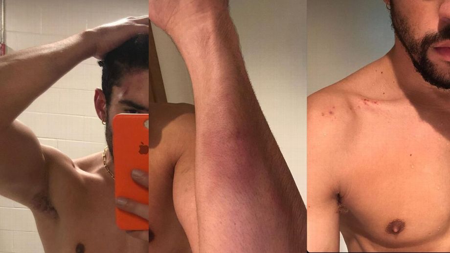 Bad-Bunny muestra foto de sus heridas en Wrestlemania