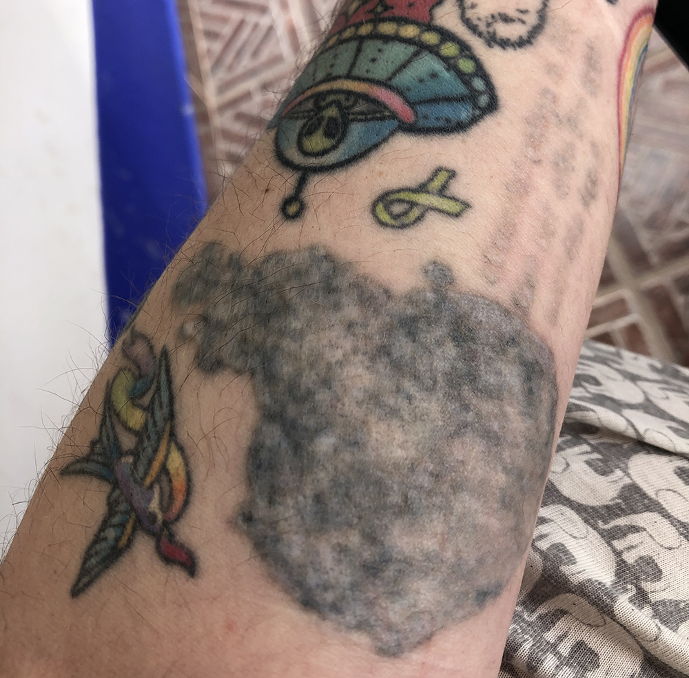 quitar tatuaje con láser