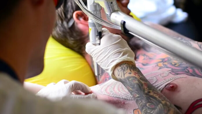 quitar tatuaje con láser