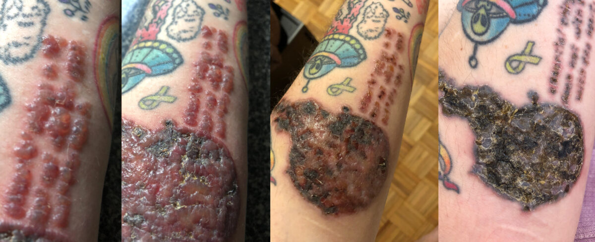 proceso de eliminación de tatuaje con láser