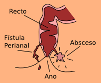 fístula padecimientos ano its infecciones de transmisión sexual