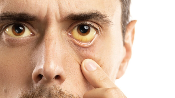 síntomas hepatitis A