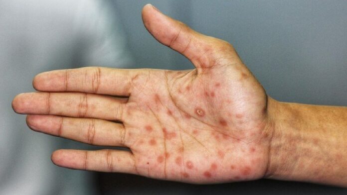 Sífilis y neurosífilis