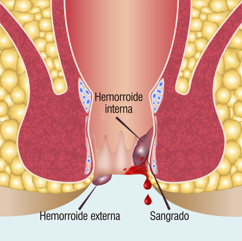 prevención de hemorroides