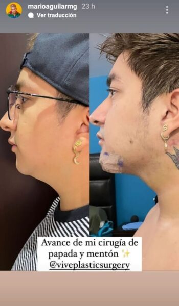Mario Aguilar mostró antes y después de lipopapada