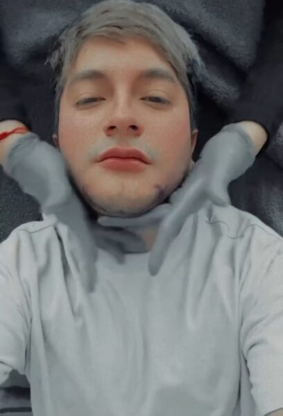 Mario Aguilar después de la lipo papada y aumento de mentón