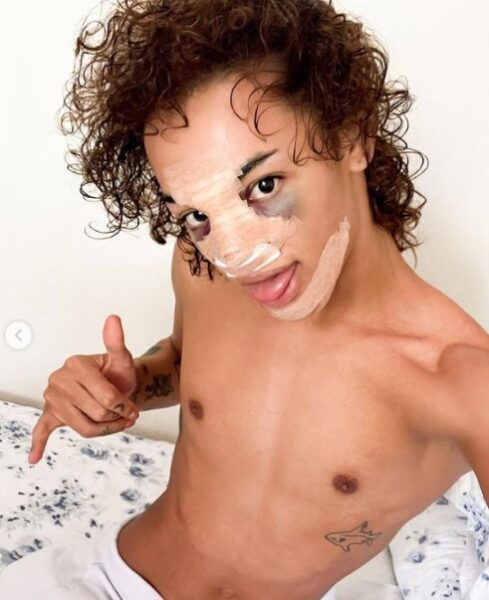 Pabllo Vittar presumió los resultados de su cirugía estética