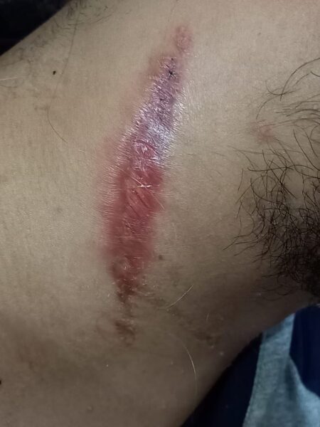 Cuello cicatrizado 'D'