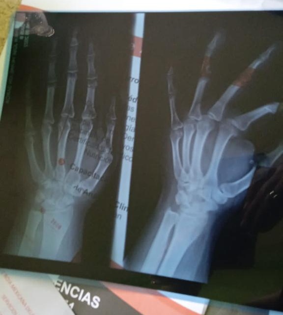 radiografías agresión hijos mamá lesbiana