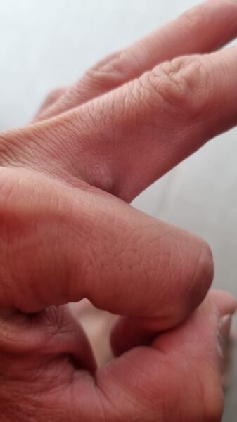 lesiones por monkeypox