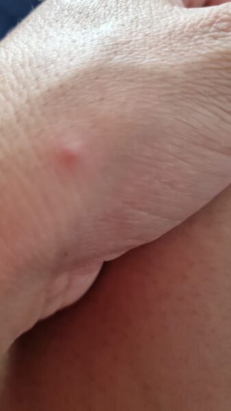 Monkeypox en paciente mexicano