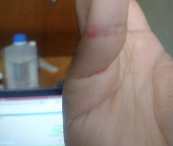 lesion leve viruela del mono en mano