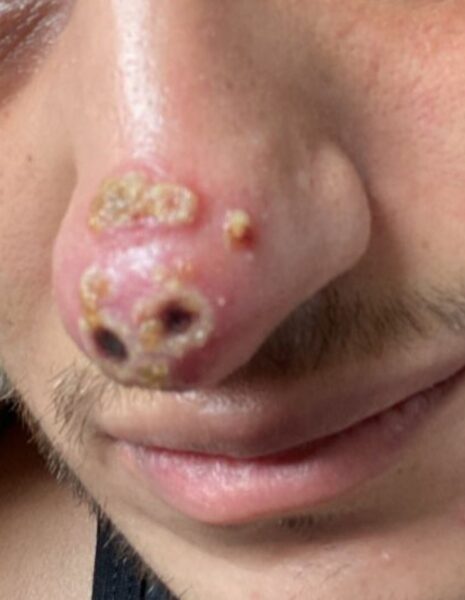 lesion nariz monkeypox