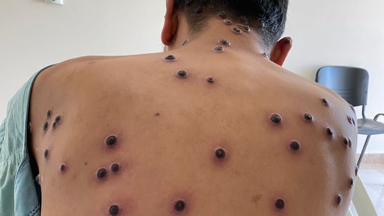 vacuna viruela símica mono monkeypox méxico vacuna viruela símica mono monkeypox méxico