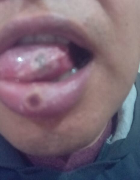 viruela símica lengua