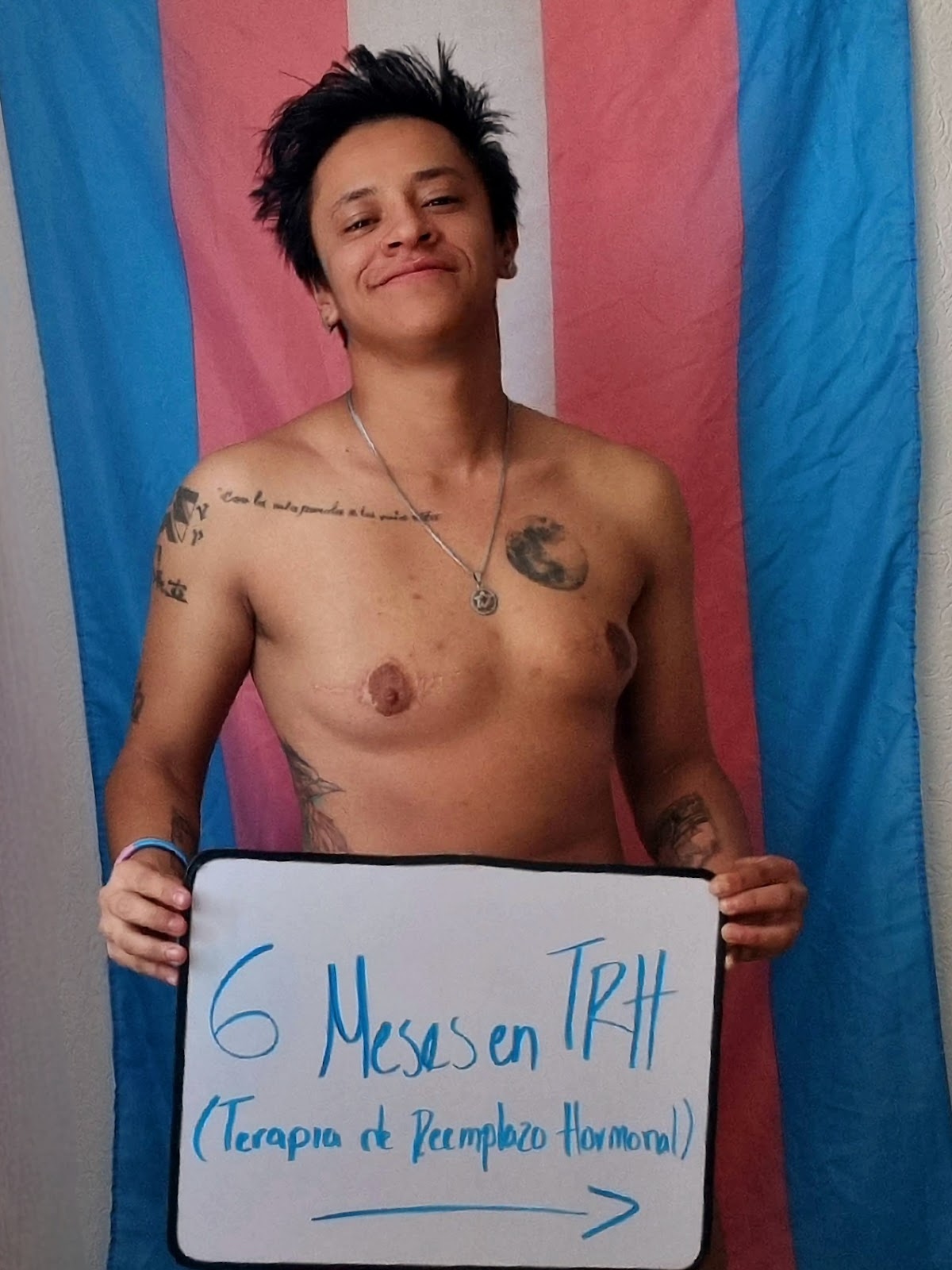 hombre trans terapia reemplazo hormonal