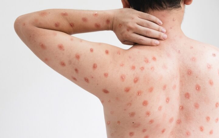 mpox viruela mono Mexico LGBT